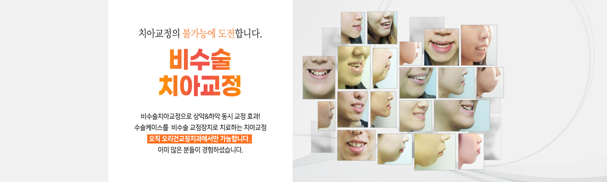 오리건 비수술 치아교정