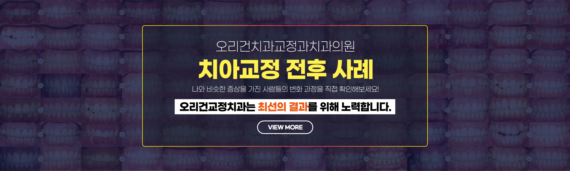 치아교정사례
