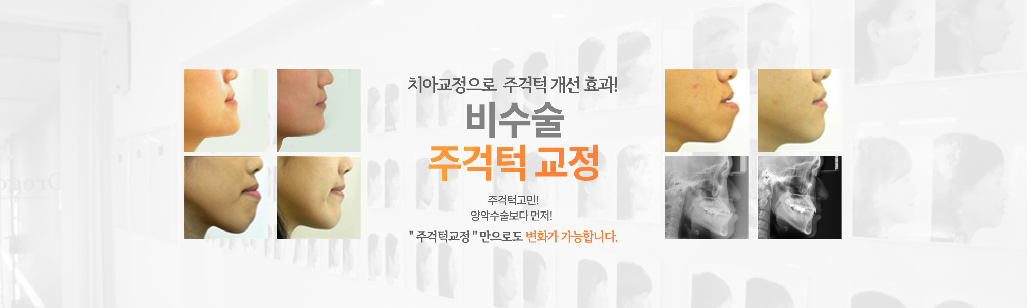 비수술 주걱턱 교정