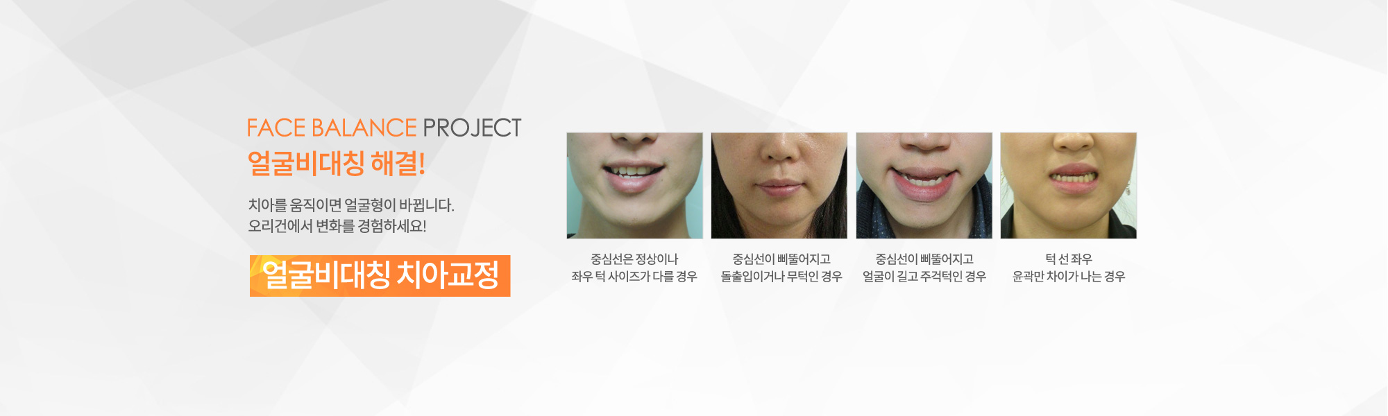 얼굴비대칭 치아교정