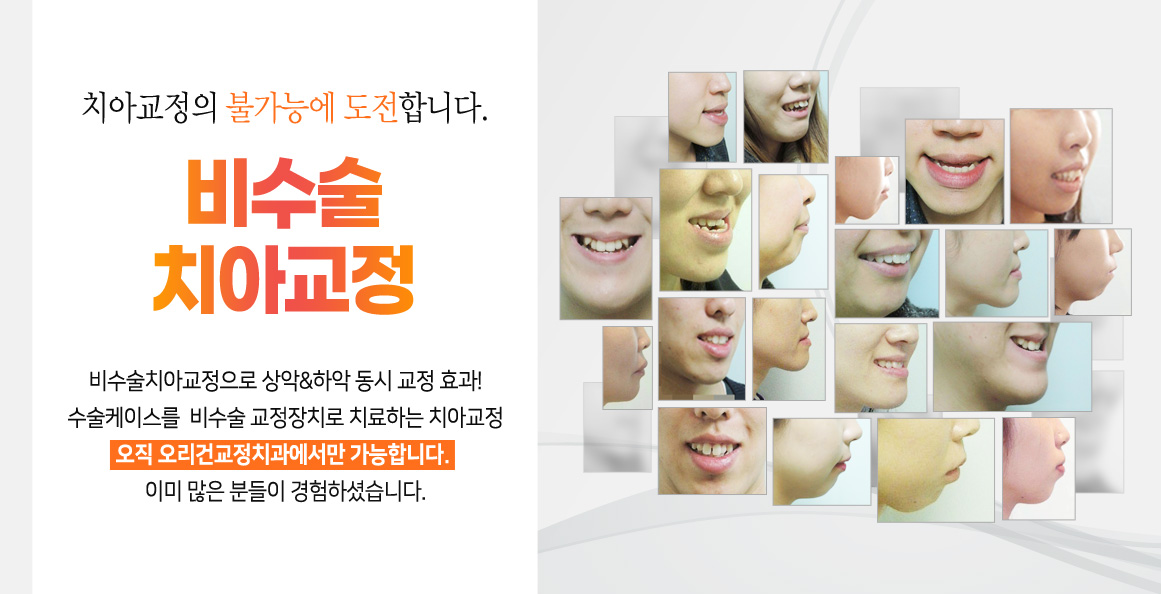 오리건 비수술 치아교정