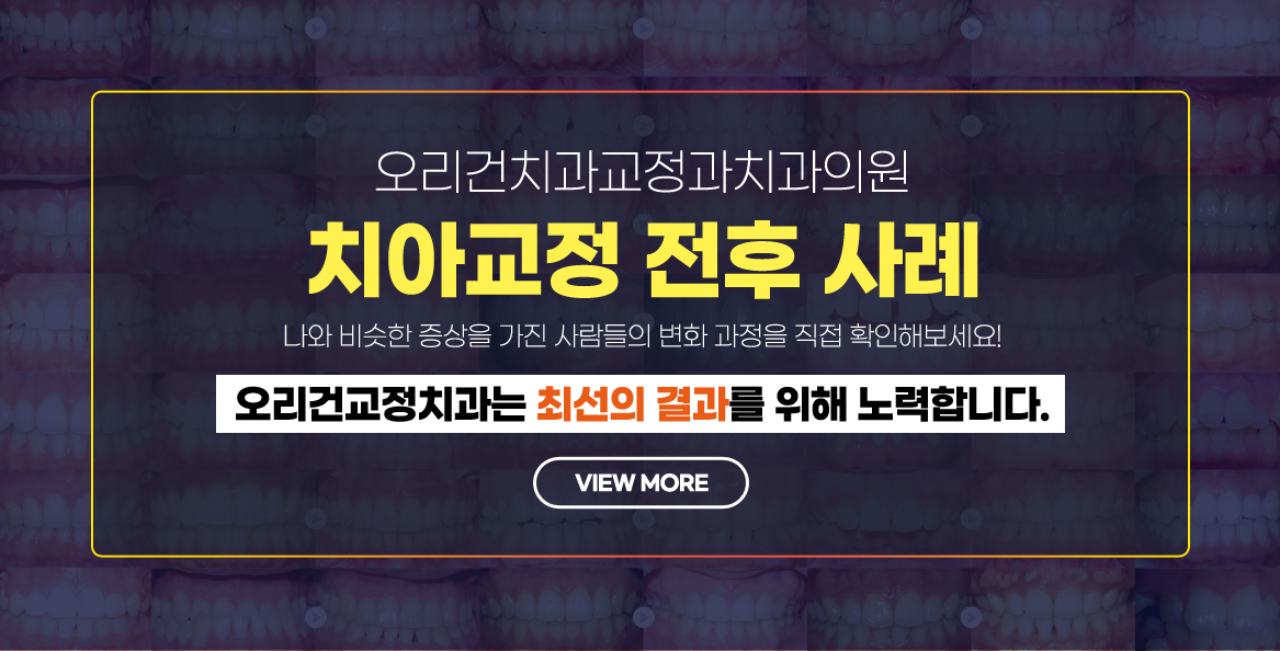 치아교정사례