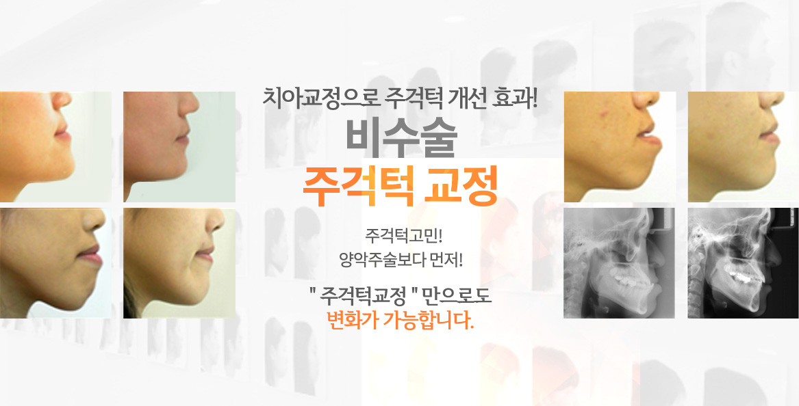 비수술 주걱턱 교정