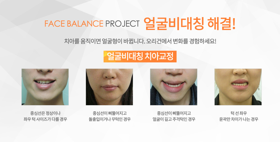 얼굴비대칭 치아교정